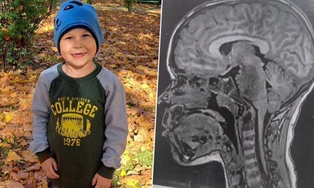 Chłopiec ma złośliwego guza, który rozlał się na cały pień mózgu