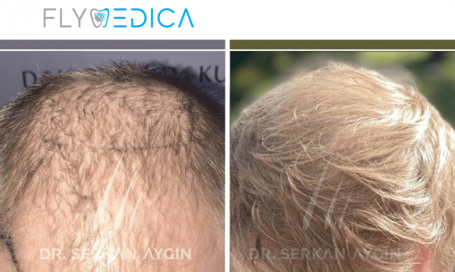 Jak wybrać najlepszego lekarza do przeszczepu włosów w Turcji?